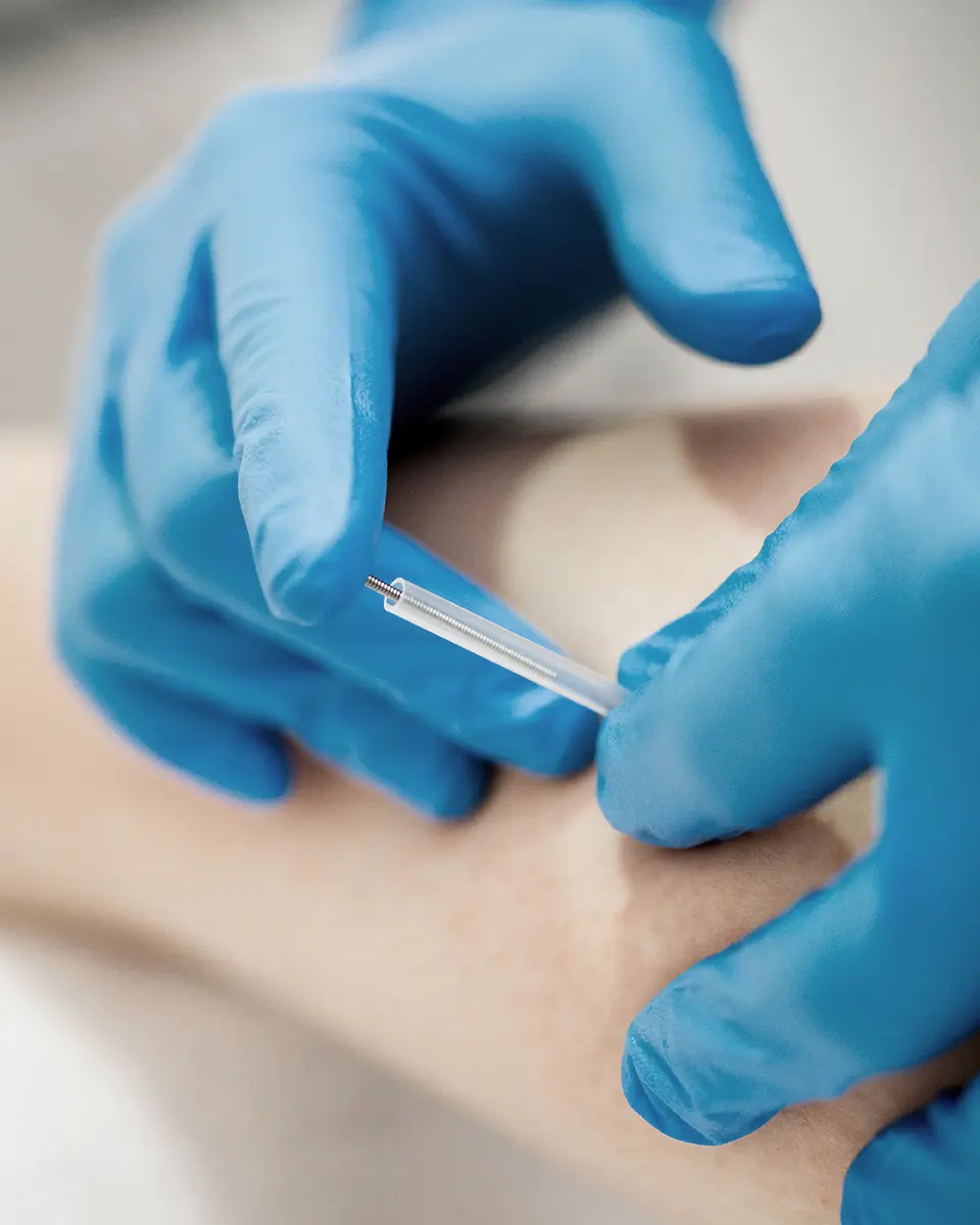 Dry Needling: What It Is and How It Can Relieve Your Pain