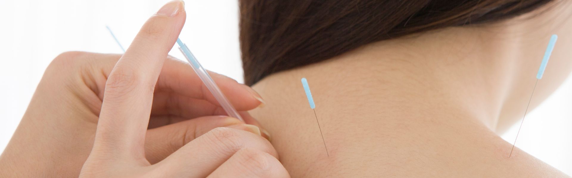 Acupuncture Abbotsford, BC Expert Acupuncture Services