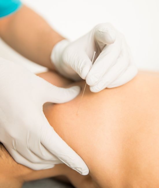 Dry Needling Physiotherapy Treatments Dry Needling Physiotherapy Treatments